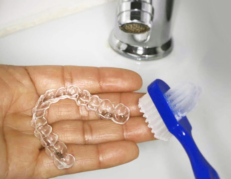 clear aligners can be easily removed
