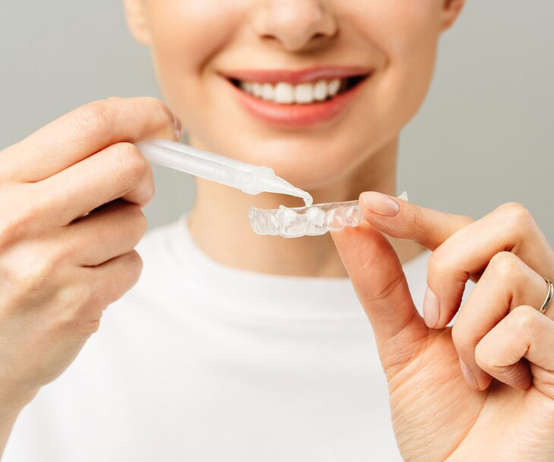 custom-fitted whitening trays
