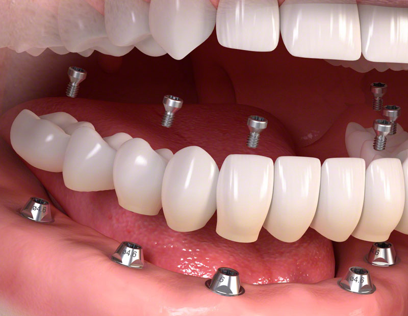 full mouth dental implants placerville-golden grove dental placerville