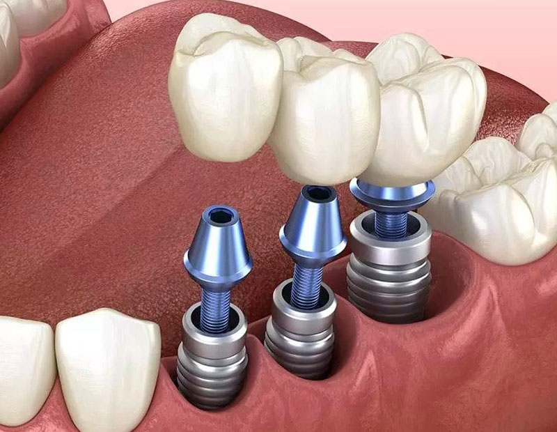 multiple dental implants in placerville-golden grove dental placerville