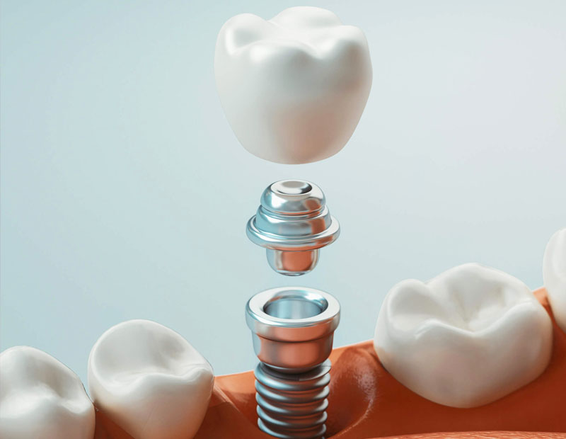 single tooth dental implants placerville-golden grove dental placerville