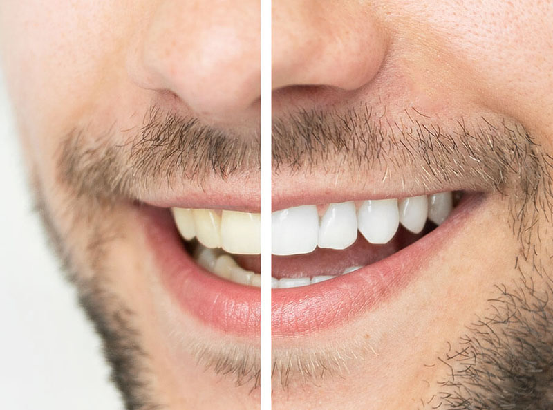 teeth whitening in placerville - golden grove dental placerville