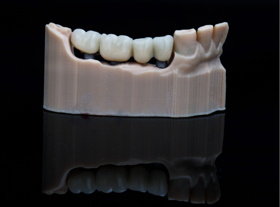 Dental Bridges in Placerville