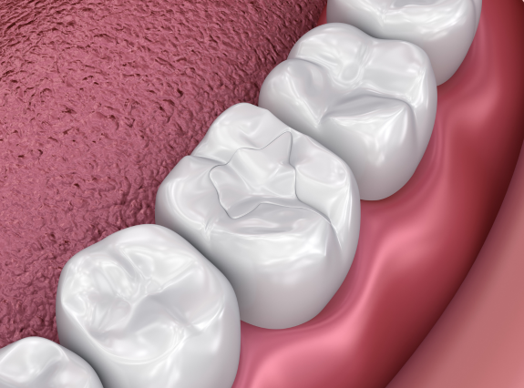 dental filling in placerville-Golden Grove Dental Placerville 