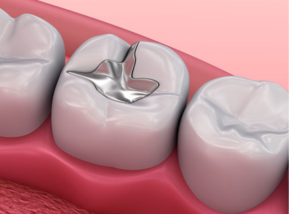 Dental Onlays in Placerville-Golden Grove Dental Placerville 