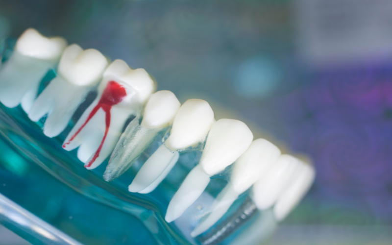 how technology is revolutionizing root canal treatment