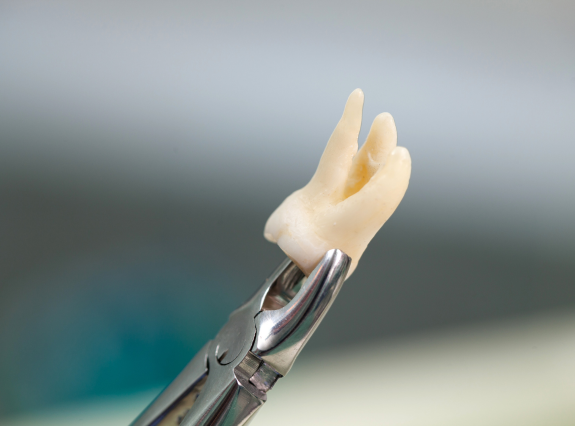Tooth Extractions in Placerville