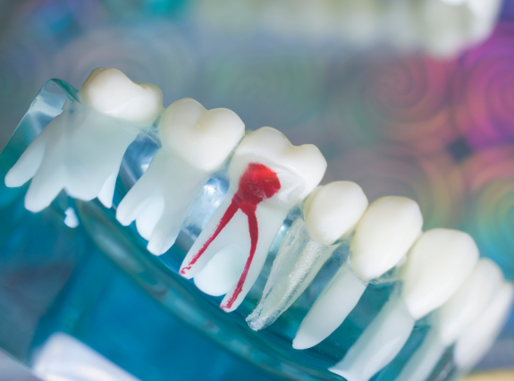 Root Canal Treatment In Placerville CA