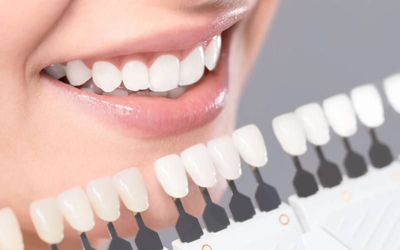 What Should You Know Before Getting Dental Veneers