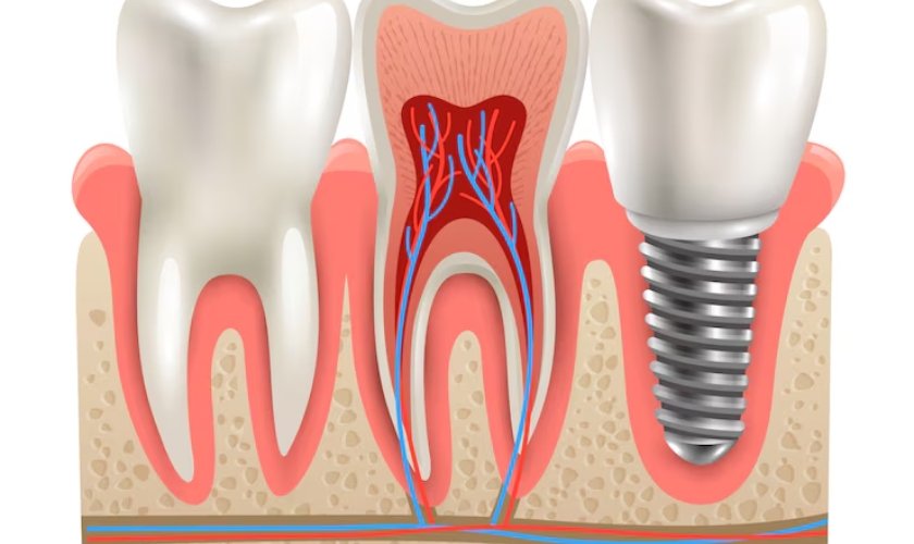 dental implant is essential for having a lifetime smile