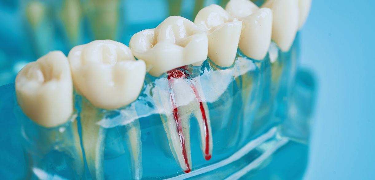 how to prepare for a root canal