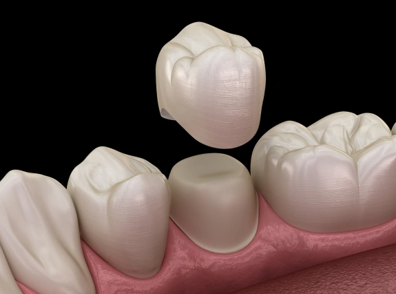 Dental Crown in Placerville