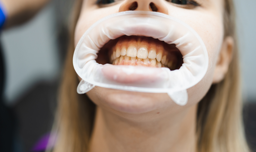 teeth whitening for receding gums