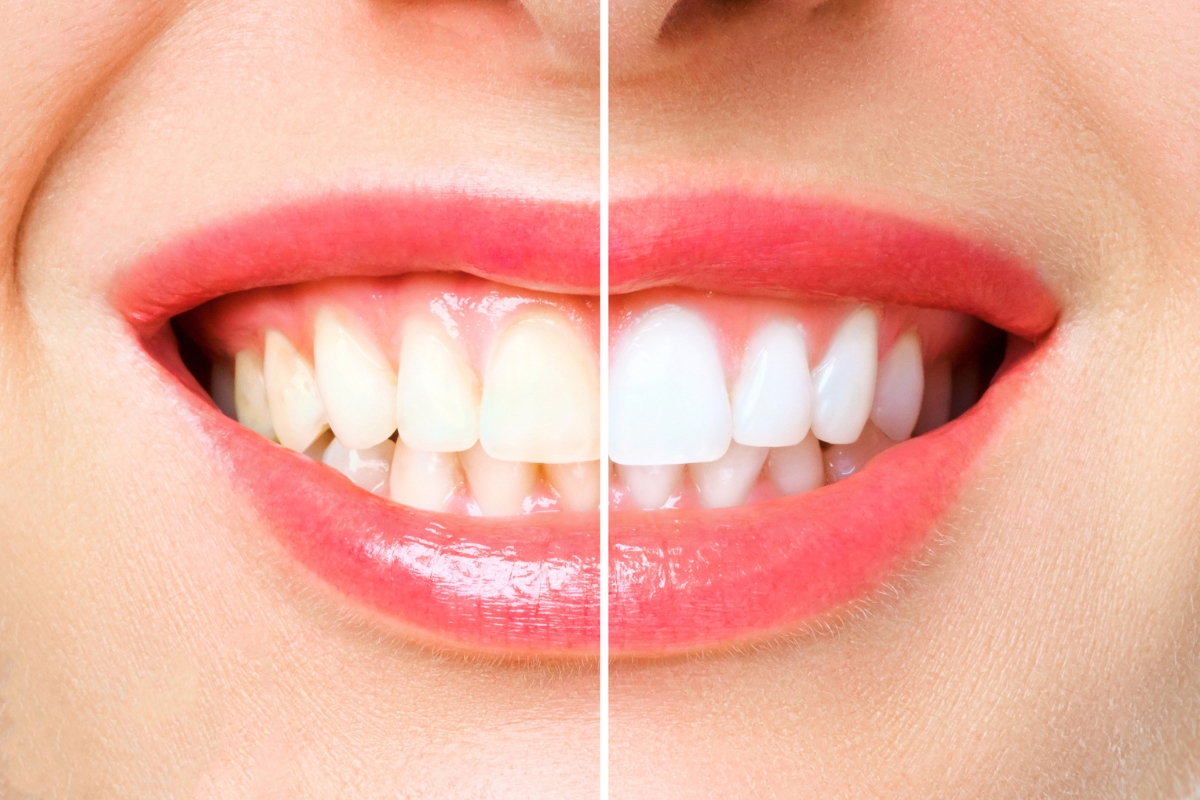 teeth-whitening-in-Placerville