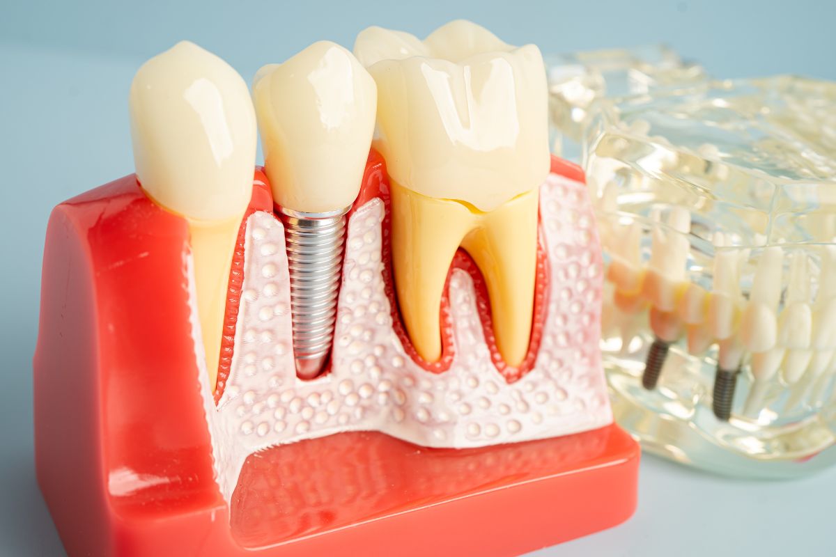 Dental Implants Placerville