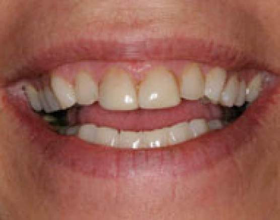 Dental Bridges in Diamond Springs